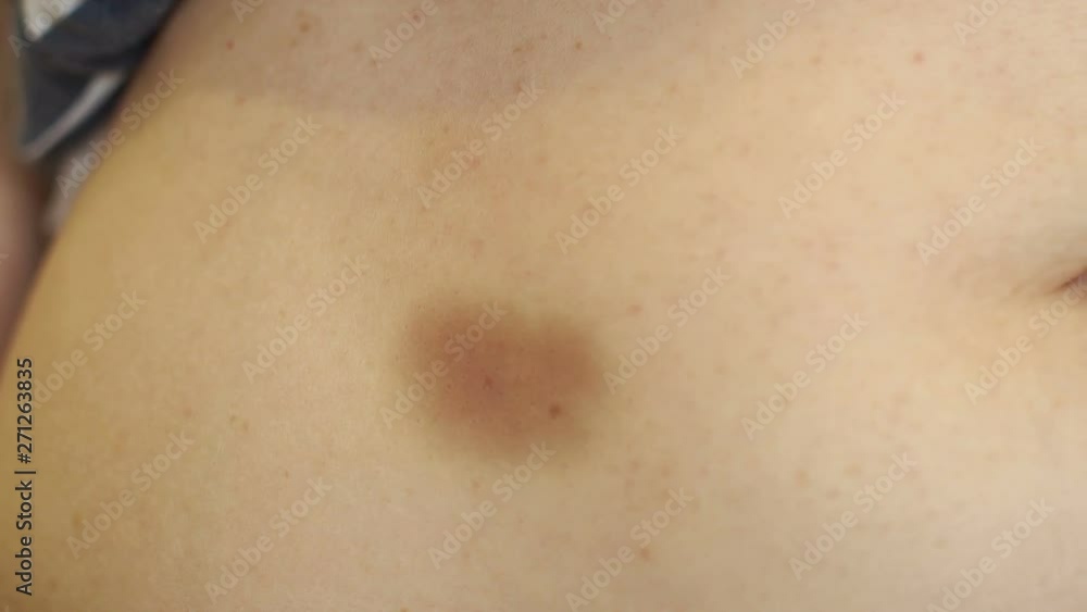 Close-up of a large bruise or bruise on the skin of the abdomen of a woman. The concept of pain close-up. Bruises on women's skin close-up.Hematoma on the abdomen of the girl from insulin injections. Close-up of a large bruise or bruise on the skin of the abdomen of a woman. The concept of pain close-up. Bruises on women's skin close-up.Hematoma on the abdomen of the girl from insulin injections.