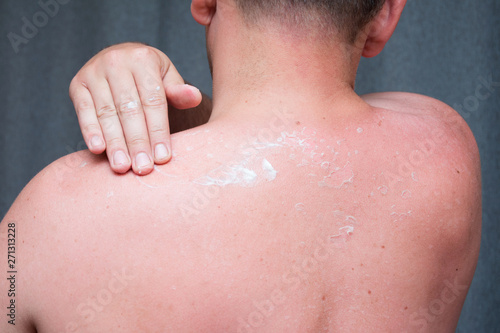 A man with reddened itchy skin after sunburn  smears cream on the skin. Skin care and protection from the sun s ultraviolet rays. 