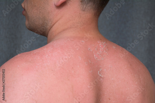 peeling skin at back and shoulder from sunburn effect on body of young man from sunbath at summer. dangerous sunburn concept  photo