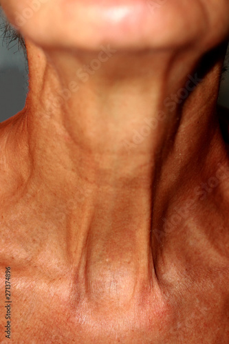 Wrinkles on the neck. Flabby skin on the neck.