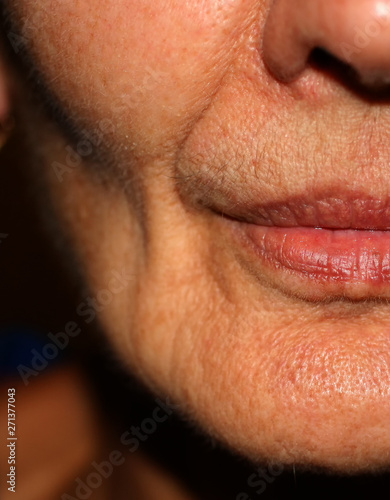 Sunken cheeks. Nasolabial folds on face. Wrinkles.
