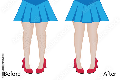 Hair removal depilation legs result  before and after procedure 