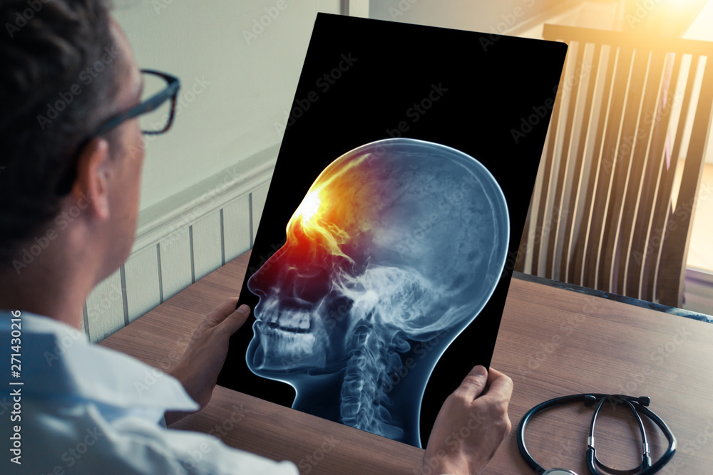Fotografia do Stock Doctor holding a xray of skull with pain in the