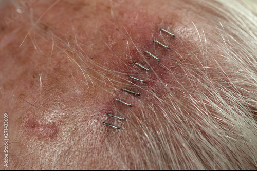 Post-surgery View of Mohs Procedure Site