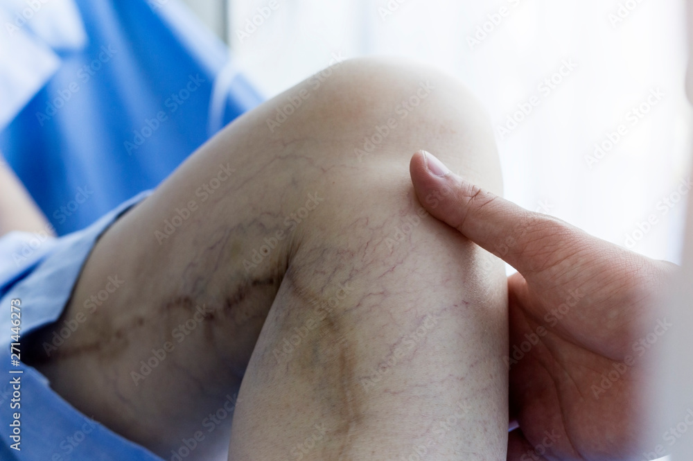 Fototapeta premium close up picture of scar on the leg, doctor is checking health in the hospital.