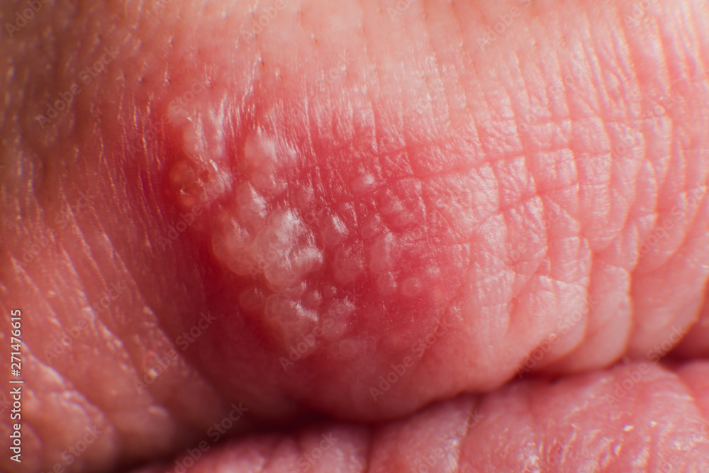 Beginning of growing herpes on caucasian male man on front upper lip super macro microscope Beginning of growing herpes on caucasian male man on front upper lip super macro microscope