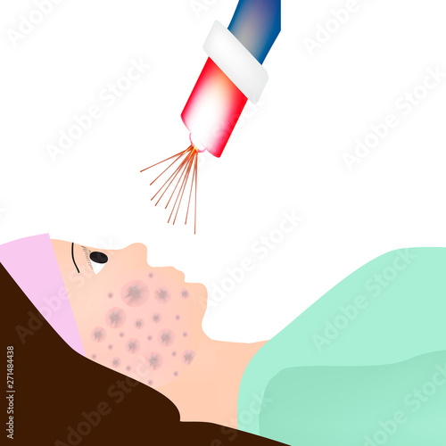 Skin scars after acne and pimples. Treatment of scars on the skin of the face with a laser. Infographics. Vector illustration on isolated background.
