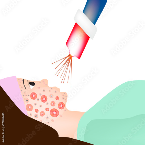 Inflamed Skin with scars, blackheads and pimples. Treatment of acne on the skin of the face with a laser. Infographics. Vector illustration on isolated background.