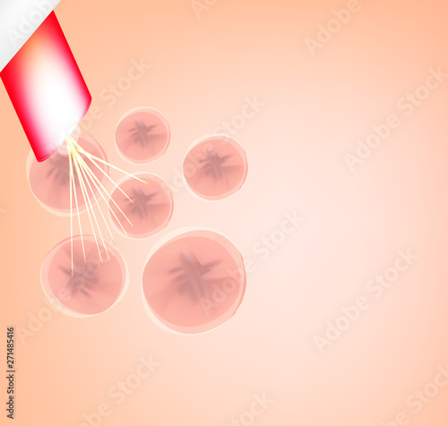 Skin scars after acne and pimples. Treatment of scars on the skin of the face with a laser. Infographics. Vector illustration on isolated background.