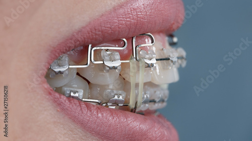 ligatures on braces for even bite, side view