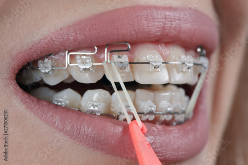 the patient uses ligatures on braces for orthodontics