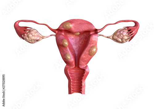 Fotótapéta uterine fibroid are benign solid tumors formed by muscle tissue