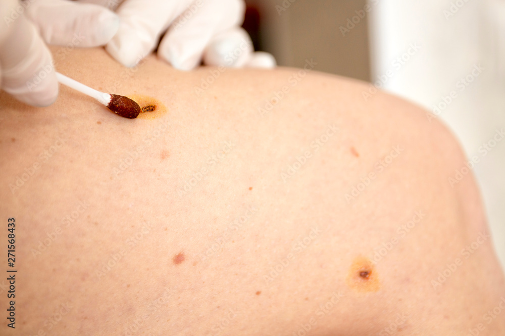 Skin scars from laser removal of moles. Skin scars from laser removal of moles.