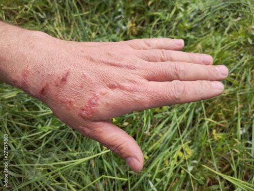 First degree burn of skin, closeup. Burns of hand, wounds. Influence poison of  Heracleum (Giant Hogweed, Cow parsnip) on skin. One week after defeat poison © dero2084