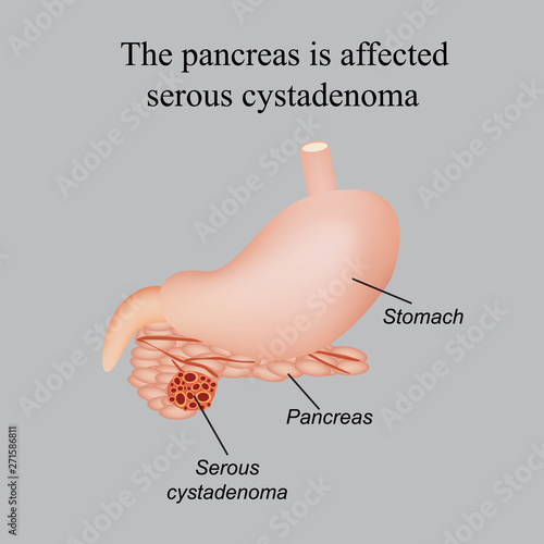 The pancreas is affected serous cystadenoma. Vector illustration on a gray background