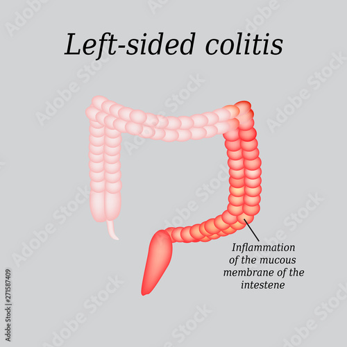 Inflammation of the large intestine divisions. Vector illustration on a gray background photo