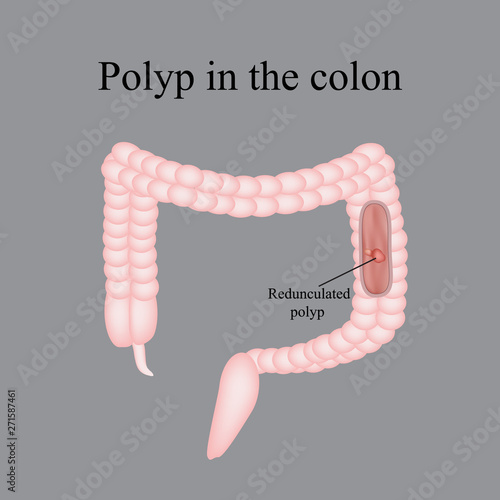 Polyp in the intestine. Polyp in the colon. Vector illustration on a gray background