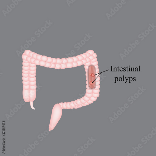 Polyp in the intestine. Polyp in the colon. Vector illustration on a gray background