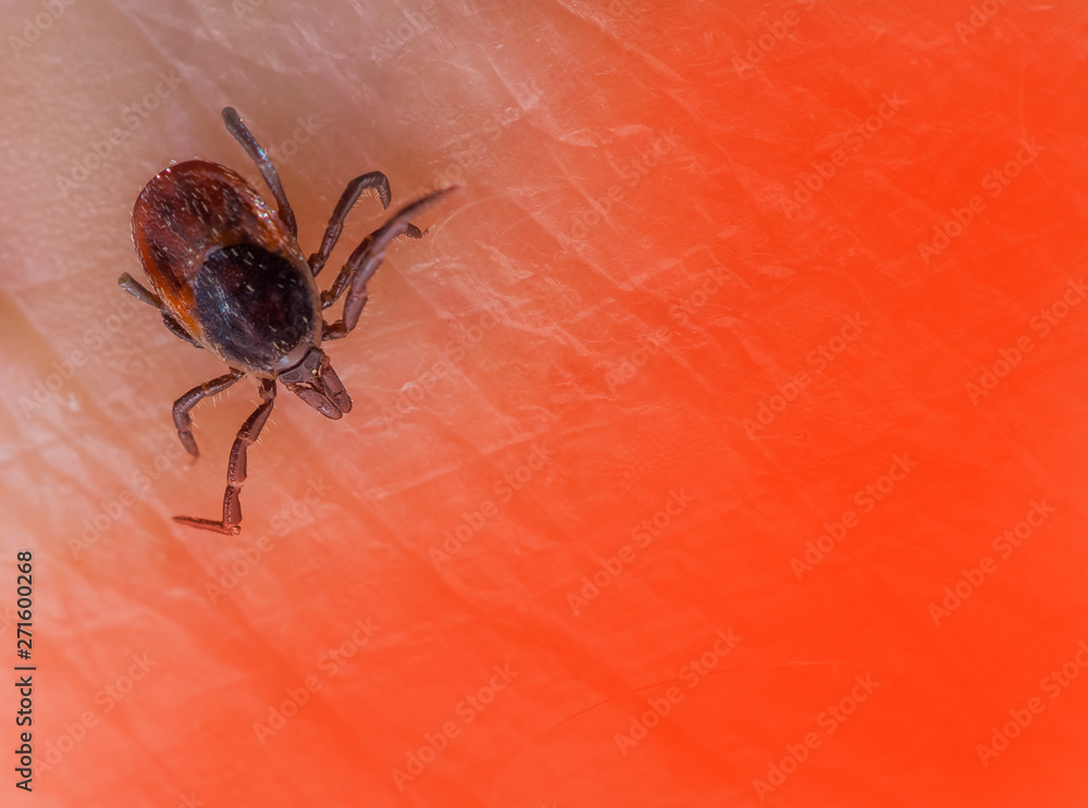 A dangerous tick runs on the skin of a human. Concept disease transmitter. A dangerous tick runs on the skin of a human. Concept disease transmitter.