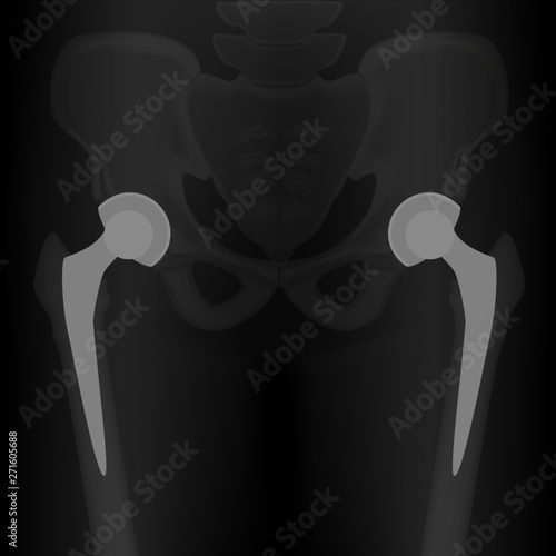 Vector illustration x-ray Pelvis and Hip joint, Bilateral hip replacement. For advertisement and medical publications.