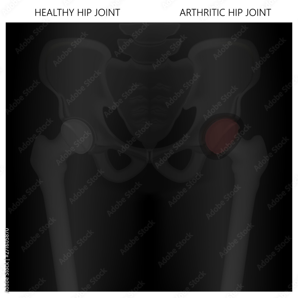 Vector illustration xray of human healthy hip and pain in arthritic