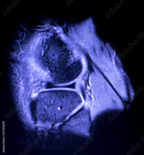 MRI knee meniscus tear scan photo