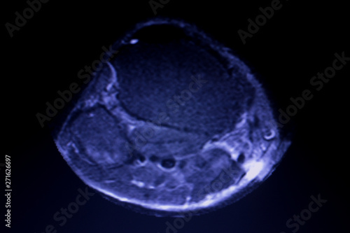 Photography MRI knee meniscus tear scan