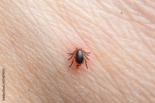 Hazardous mite, a Lyme Disease carrier bites a person.