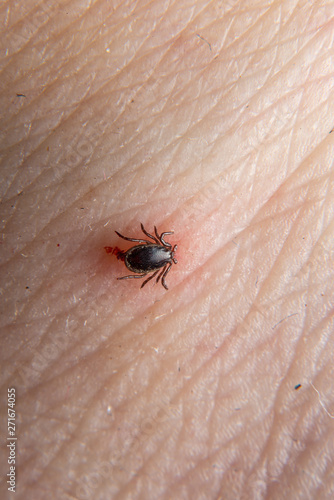 Hazardous mite, a Lyme Disease carrier bites a person.