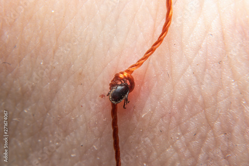 Hazardous mite, a Lyme Disease carrier bites a person. Extract the tick with a thread.