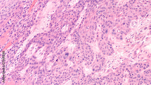 Microscopic image of invasive squamous cell carcinoma of the vulva, related to human papilloma virus (HPV).  HPV vaccination in teens can prevent HPV infections, cervical and vulvar cancer. photo