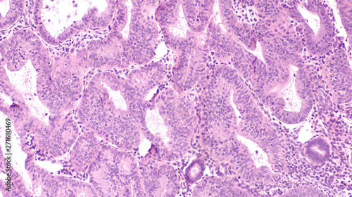 Microscopic image (photomicrograph) of complex endometrial hyperplasia with atypia, from a dilation and curettage specimen (D&C) of a woman with dysfunctional uterine (vaginal) bleeding.   photo