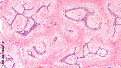 Breast Biopsy: Microscopic image (photomicrograph) of a fibroadenoma, a benign circumscribed tumor composed of both glandular and stromal tissue. photo