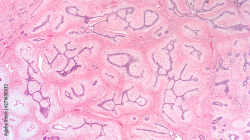 Breast Biopsy: Microscopic image (photomicrograph) of a fibroadenoma, a benign circumscribed tumor composed of both glandular and stromal tissue.