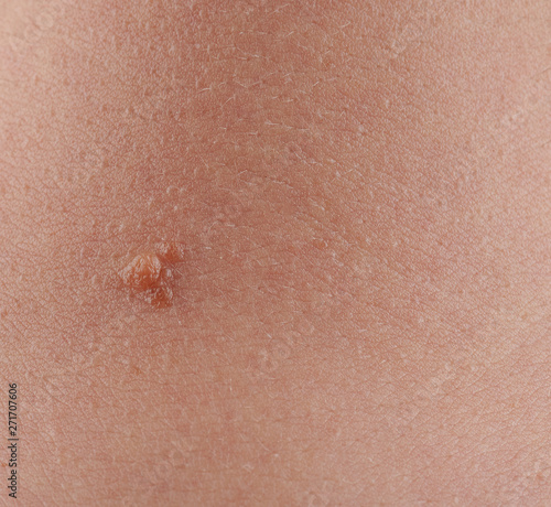 One mole spot on human skin