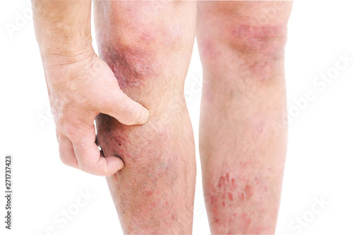 Atopic dermatitis (AD), also known as atopic eczema, is a type of skin inflammation (dermatitis) . photo