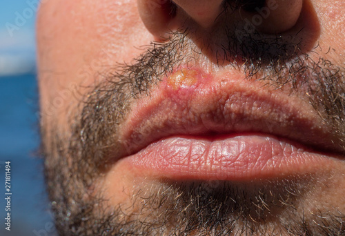 Sunburn on man lips closeup. Sun burn or bacterial infection on skin. Skin medical problem. Virus or bacterial inflammation