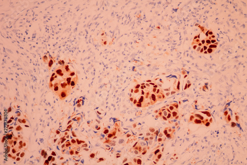 View in microscopic of pathology cross section tissue ductal cell carcinoma or adenocarcinoma diagnosis by pathologist in laboratory.Immunohistochem stain.Breast cancer hormone receptor.