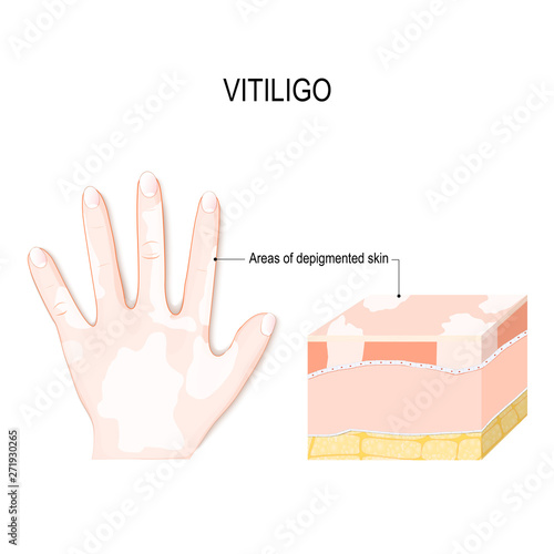 Vitiligo. Is a skin condition characterized by portions of the skin losing their pigment