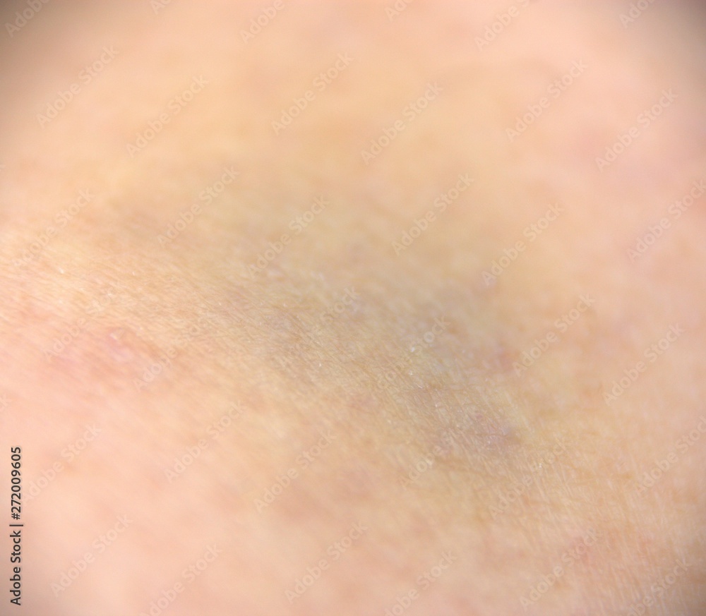 hématome bleu sur peau en gros plan hématome bleu sur peau en gros plan