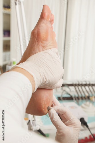Chiropodist removes skin on a wart with