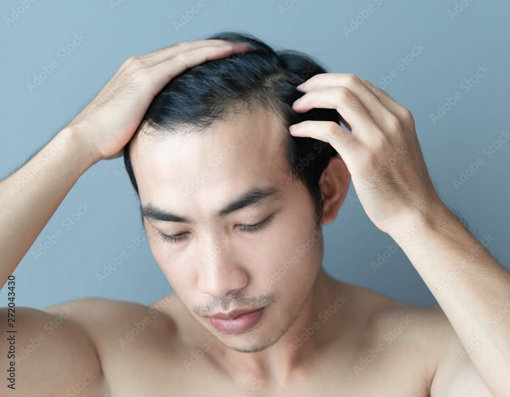 Young man serious hair loss problem for health care medical and shampoo product concept Young man serious hair loss problem for health care medical and shampoo product concept