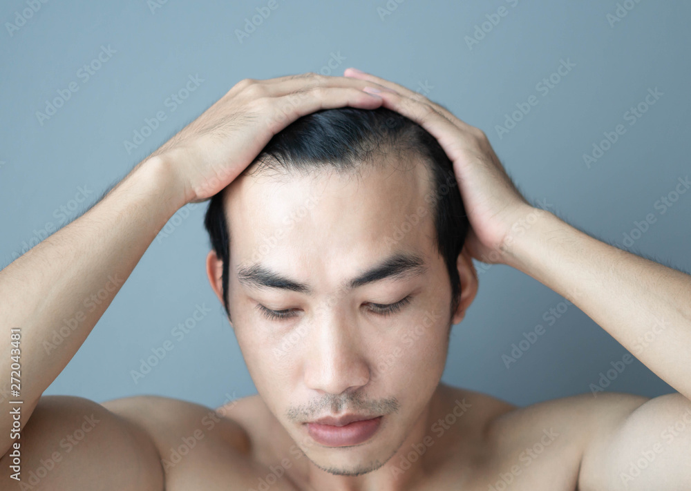 Young man serious hair loss problem for health care medical and shampoo product concept Young man serious hair loss problem for health care medical and shampoo product concept