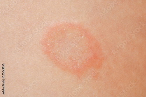 Mycosis infection on the human skin. It is caused by a fungus