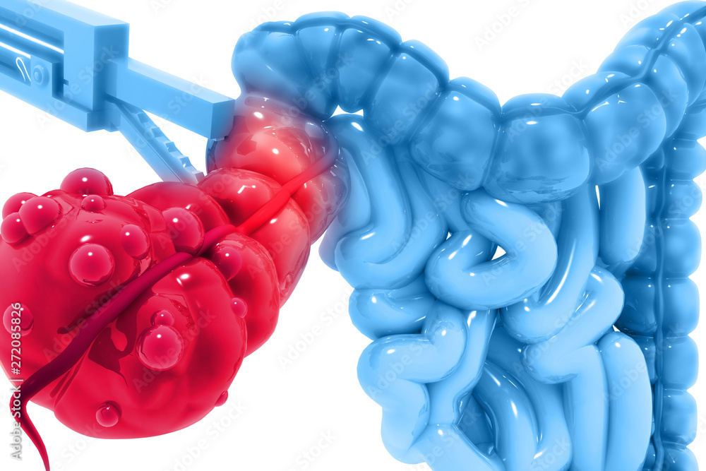 Appendix Surgery Stock Illustration Adobe Stock Appendix Surgery Stock Illustration Adobe Stock