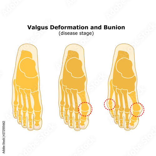 Age and valgus deformity of the thumb. Bunion. Stages of development of the disease. Silhouette of the foot bones. Vector illustration