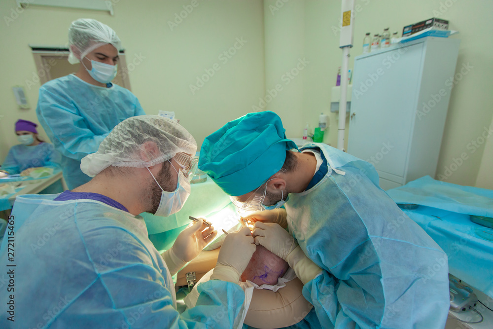 Baldness treatment. Hair transplant. Surgeons in the operating room carry out hair transplant surgery. Surgical technique that moves hair follicles from a part of the head. Baldness treatment. Hair transplant. Surgeons in the operating room carry out hair transplant surgery. Surgical technique that moves hair follicles from a part of the head.