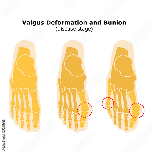 Age and valgus deformity of the thumb. Bunion. Stages of development of the disease. Silhouette of the foot bones. Vector illustration