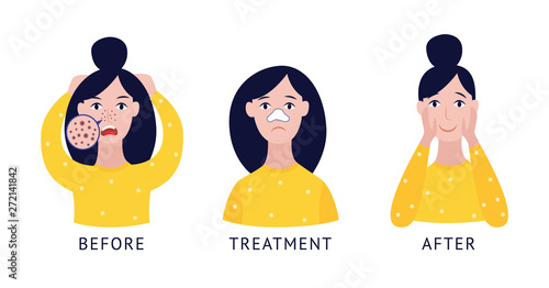 Set of woman with nose blackheads before and after treatment cartoon flat style