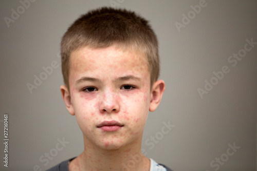 Cuadro en lienzo Portrait of sick sad boy child suffering from measles or chicken pox with bumps all over face